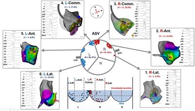 Idiopathic Ventricular Arrhythmias Ablated in Different Subregions of the Aortic Sinuses of Valsalva: Anatomical Distribution, Precordial Electrocardiographic Notch Patterns, and Bipolar Electrographic Characteristics